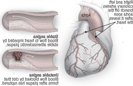 Stabilní a nestabilní angina pectoris