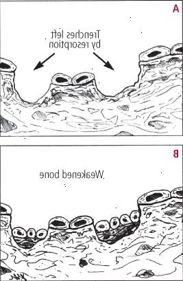 Je-li kostní ztrátě