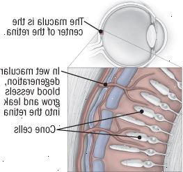 Makulární degenerace