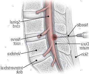Podívejte se na dvou vstřikovacích terapie: epidurální injekci steroidu
