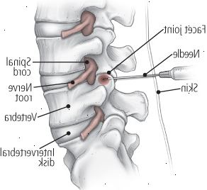 Podívejte se na dvou vstřikovacích terapie: aspekt společné vstřikování
