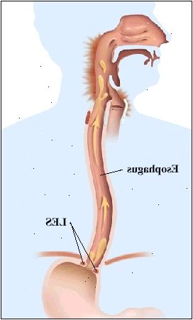 Nástin lidské postavy znázorňující anatomii horní části trávicího systému z úst do žaludku. Jícen prochází bránicí připojení k žaludku. Slabá LES je otevřený a šipky ukazují pohyb žaludečního obsahu do jícnu a do zadní části krku. Zpět hrdla se zanítí.