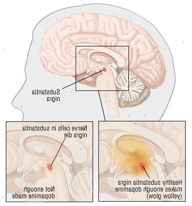 Parkinsonova Parkinsonova