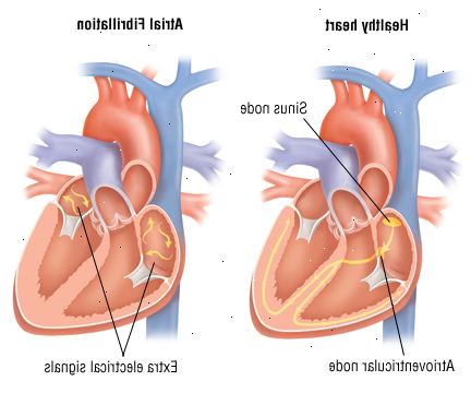 Fibrilace síní 1