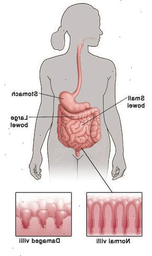 Přehled lidská postava znázorňující trávicí systém a poukazuje na to žaludek, tenké střevo a tlusté střevo. Detail ukazuje normální klků jako masité prstovité stonky lemující střeva ve srovnání s krátkou, poškozených klků.
