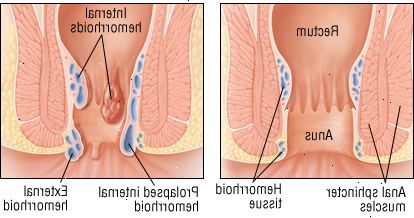 Hemoroidy
