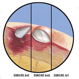 Průřez kůže ukazuje první stupeň hoří poškození vrchní vrstvy kůže, druhý stupeň hoří poškození hlubokých vrstev pokožky a vytváří puchýře, a třetí stupeň popálení zničení horní vrstvy kůže a poškození hlubokých tkání.