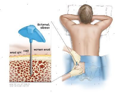 Aspirace kostní dřeně a biopsie, kresba ukazuje pacienta ležícího lícem dolů na stůl a Jamshidi jehlu (dlouhé, duté jehly) je vložena do kyčelní kosti. Vložka ukazuje Jamshidi jehly byla vložena přes kůži do kostní dřeně z kyčelní kosti.