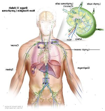 Etapa III dospělý non-Hodgkinův lymfom. Rakovina se nachází v jedné nebo více skupin lymfatických uzlin nad a pod membránou (a). V kroku IIIE, rakovina se vyskytuje v lymfatických uzlin skupinách nad a pod membránou a mimo lymfatických uzlin v blízkém orgánu nebo prostoru (B). V prvním stupni IIIS, rakovina se vyskytuje v lymfatických uzlin skupinách nad a pod membránou (a) a ve slezině (c). Ve fázi IIIS navíc E, rakovina se vyskytuje v lymfatických uzlin skupinách nad a pod membránou, mimo lymfatických uzlin v blízkém orgánu nebo prostoru (B), a ve slezině (c). Etapa III dospělý non-Hodgkinův lymfom. Rakovina se nachází v jedné nebo více skupin lymfatických uzlin nad a pod membránou (a). V kroku IIIE, rakovina se vyskytuje v lymfatických uzlin skupinách nad a pod membránou a mimo lymfatických uzlin v blízkém orgánu nebo prostoru (B). V prvním stupni IIIS, rakovina se vyskytuje v lymfatických uzlin skupinách nad a pod membránou (a) a ve slezině (c). Ve fázi IIIS navíc E, rakovina se vyskytuje v lymfatických uzlin skupinách nad a pod membránou, mimo lymfatických uzlin v blízkém orgánu nebo prostoru (B), a ve slezině (c).
