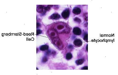 Reed-Sternberg buňky. Reed-Sternberg buňky jsou velké, abnormální lymfocyty, které mohou obsahovat více než jedno jádro. Tyto buňky se nacházejí v Hodgkin lymfom. Reed-Sternberg buňky. Reed-Sternberg buňky jsou velké, abnormální lymfocyty, které mohou obsahovat více než jedno jádro. Tyto buňky se nacházejí v Hodgkin lymfom.