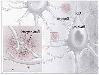 Beta-amyloid plakety Beta-amyloid plakety