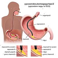 Ilustrace Ezofagogastroduodenoskopie řízení