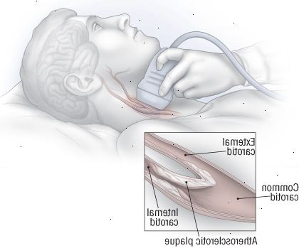 Ultrazvuková vyšetření karotid