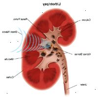 Ilustrace litotrypsi