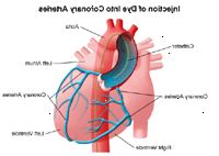 Ilustrace koronárních tepen po injekci barviva použitého v srdeční katetrizace nebo PTCA