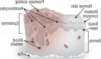 Anatomie psoriázy