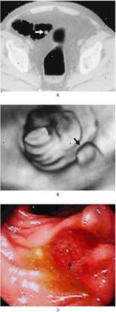 Kolorektální polyp v sigmatu pohledu pomocí CT (A), virtuální kolonoskopie (B), a konvenční kolonoskopie (C).