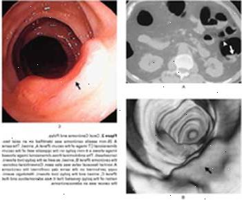 Karcinom a slepého střeva polyp zobrazeno pomocí CT (A), virtuální koloskopie (B), a konvenční kolonoskopie (C).